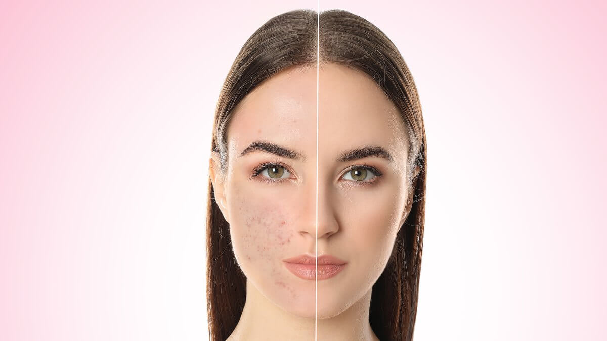 Split face acne comparison showing smoother, clearer skin after using LightStim for Acne LED light therapy treatment at home