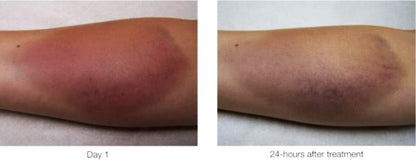 Before and after treatment with LightStim for Pain, showing significant bruise reduction on an arm over 24 hours