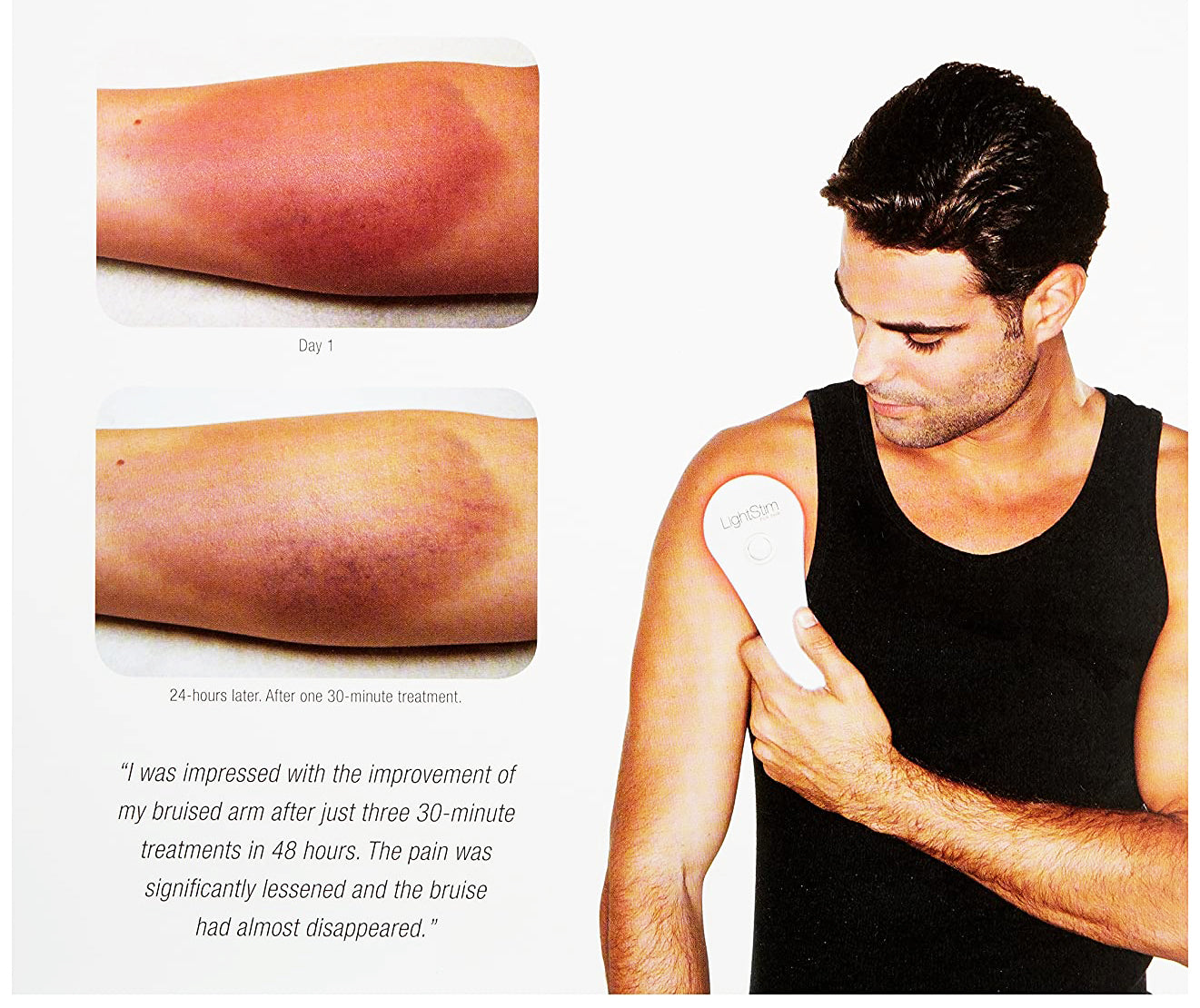 Before and after photos of a bruised arm treated with LightStim for Pain, showing significant reduction in bruising