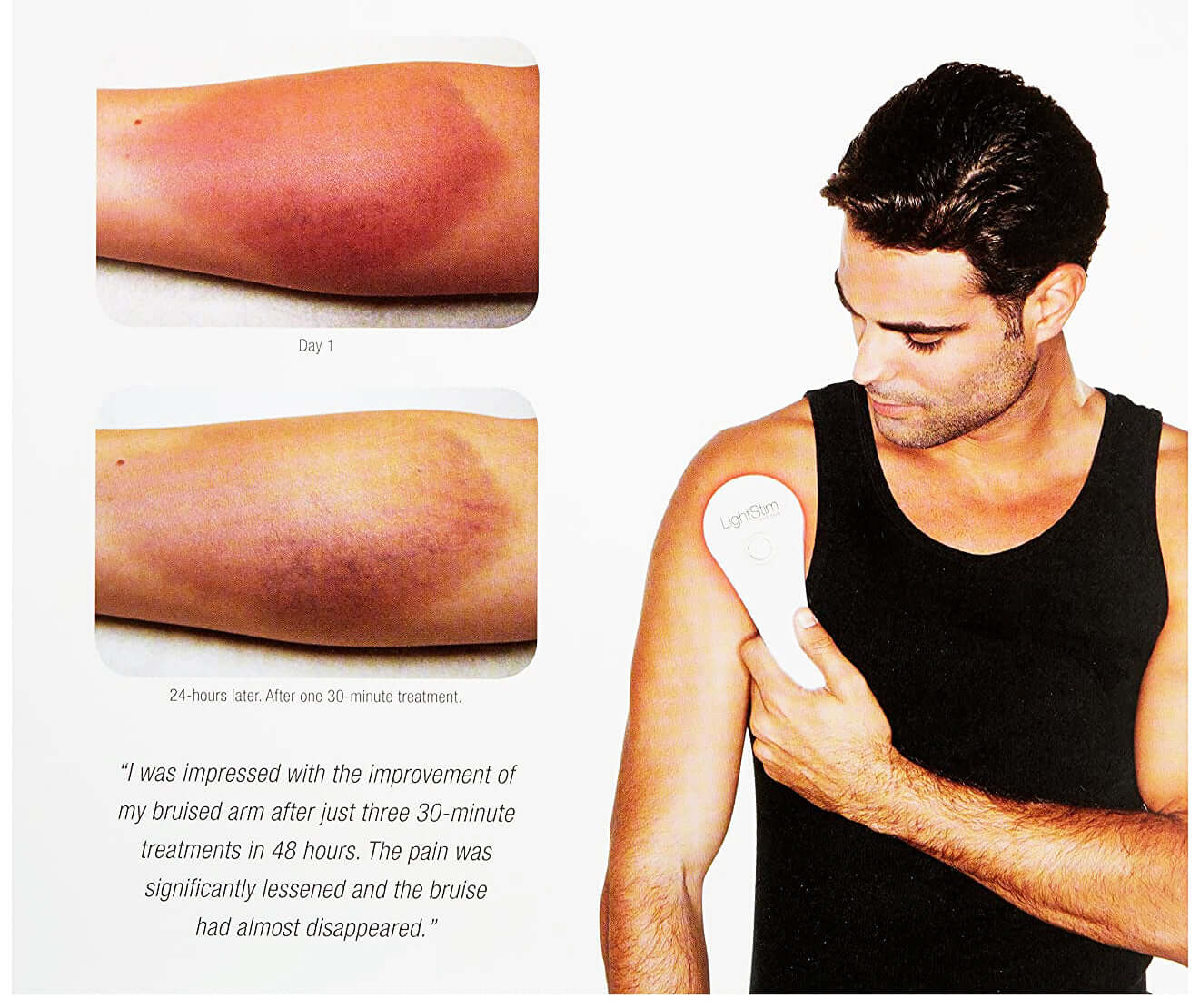 LightStim for Pain device shown on shoulder with before and after bruise results for red light therapy support for recovery.