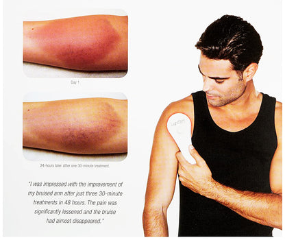 Before and after photos of a bruised arm treated with LightStim for Pain, showing significant reduction in bruising