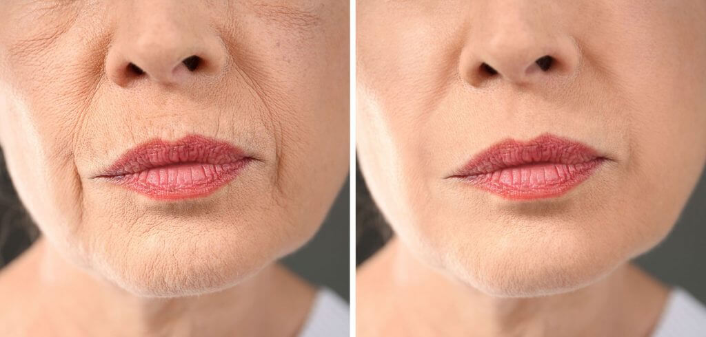 LightStim for Wrinkles before and after lower face comparison showing smoother smile lines and firmer skin with LED therapy.