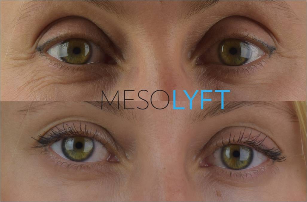 MesoLyft- Eye before and after