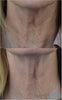mesolyft neck before and after