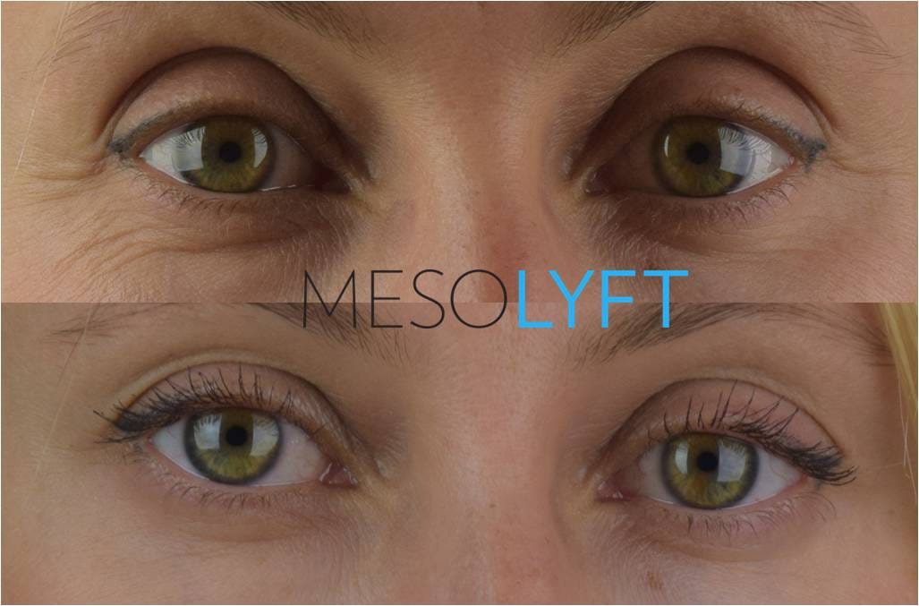 Close-up before and after view of MesoLyft Eyes treatment showing visible reduction in fine lines