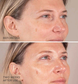 MesoLyft- Eyes (NON-REFUNDABLE)-The Skin Spot