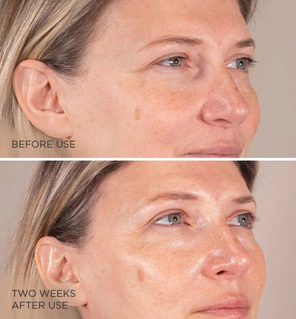 Before and after using MesoLyft Eyes over two weeks, showing noticeable reduction in under-eye wrinkles and improved skin texture