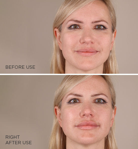 Before and after results using MesoLyft Lips, showing enhanced lip fullness and smoother texture immediately after use