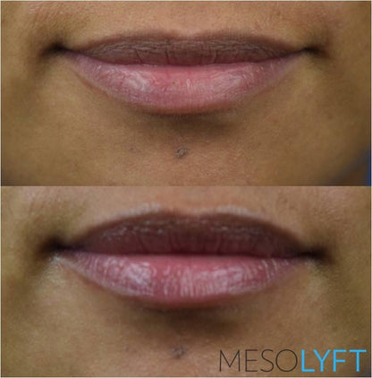 Close-up before and after using MesoLyft Lips showing improved lip texture and increased hydration