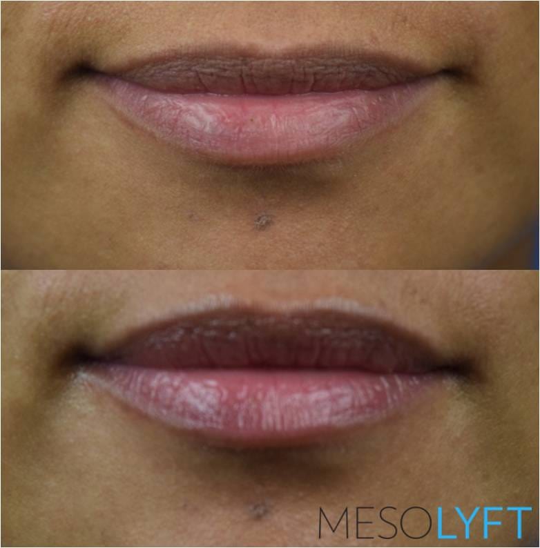 Close-up before and after using MesoLyft Lips showing improved lip texture and increased hydration