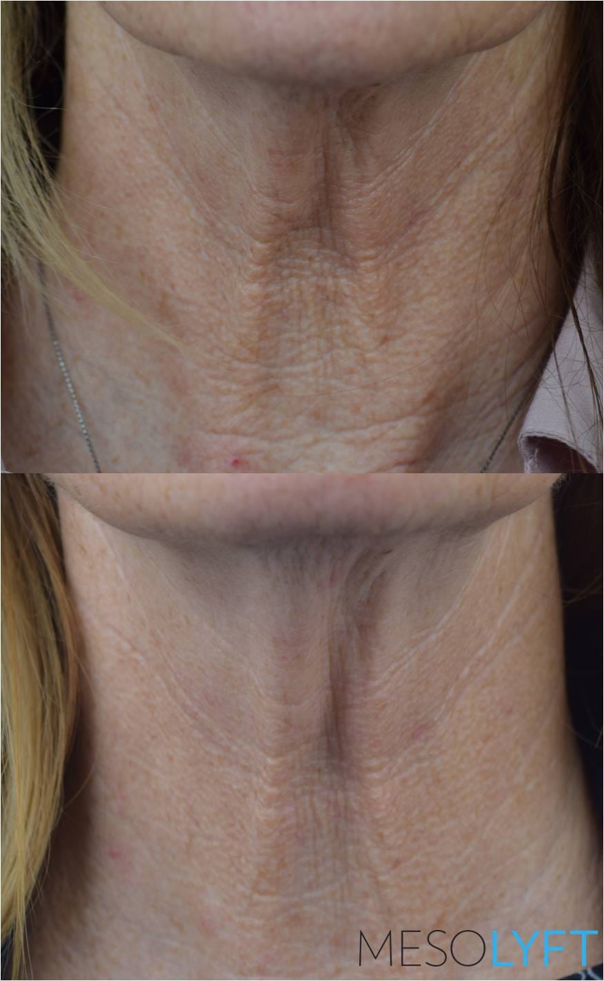 Close-up before and after view of MesoLyft Neck treatment showing significant reduction in deep neck wrinkles