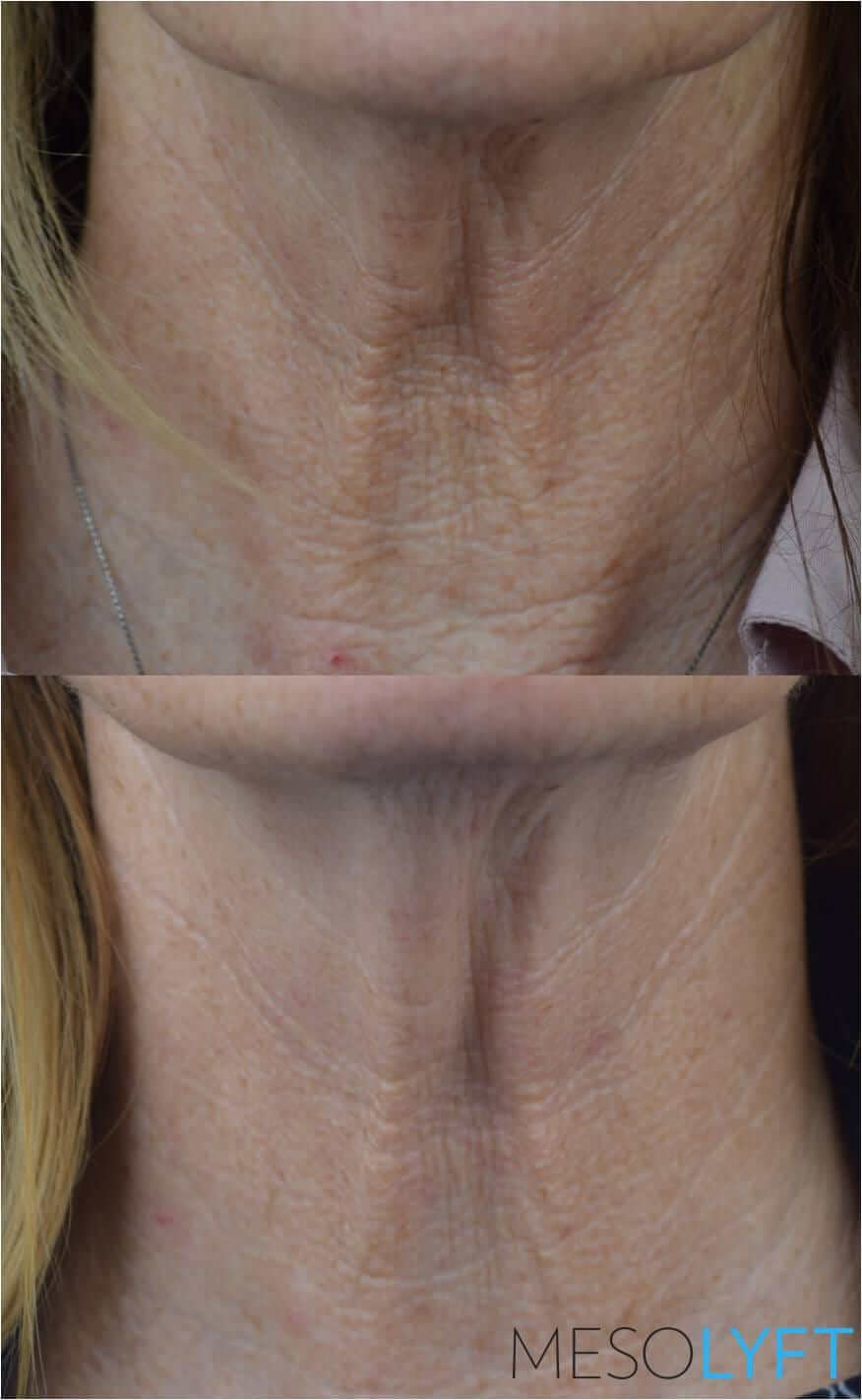 MesoLyft Neck close-up before and after showing textured neck skin and smoother looking skin with firming care results view.