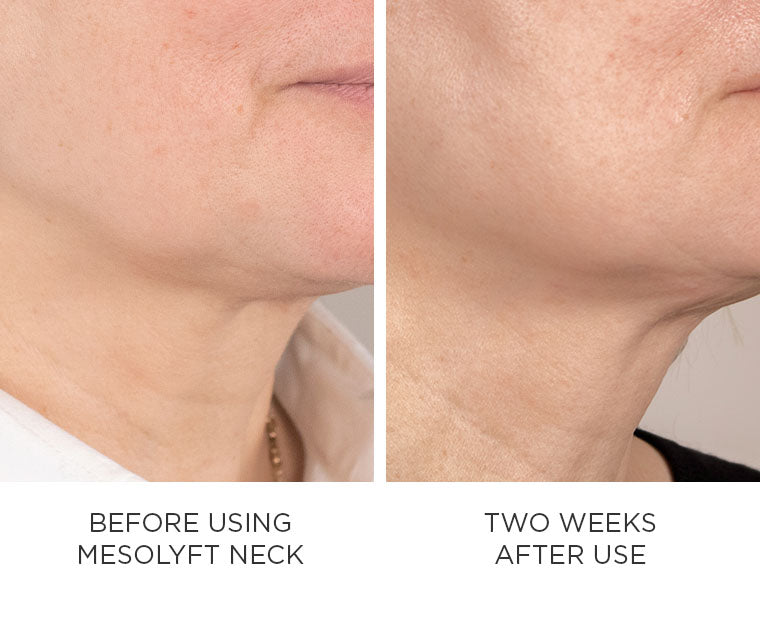 Before and after using MesoLyft Neck, showing visible improvement in skin texture and reduction in neck wrinkles after two weeks