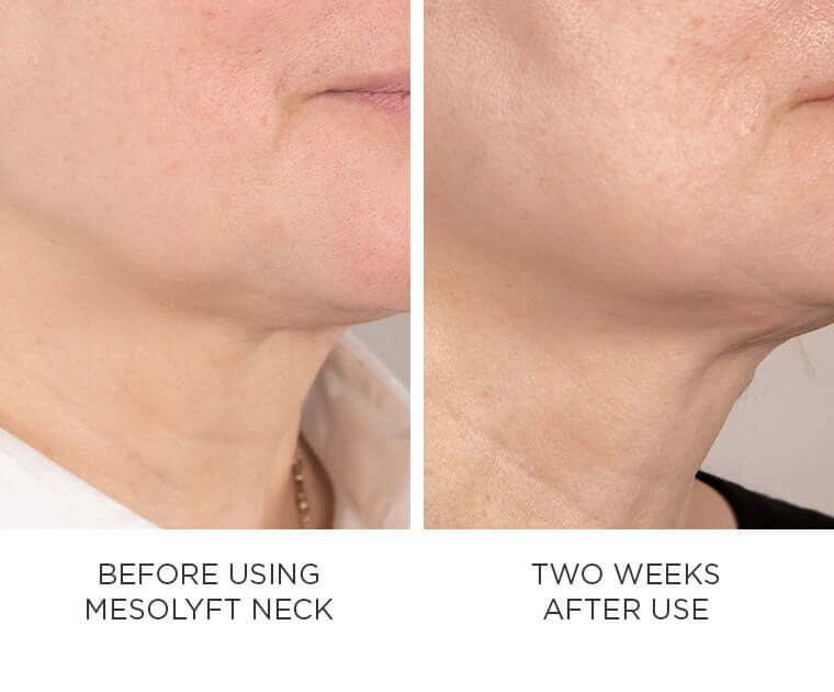 MesoLyft Neck before and after shows two week neck texture comparison for fine lines, firmness, and smoother skin care now