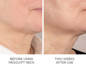 MesoLyft- Neck (NON-REFUNDABLE)-The Skin Spot