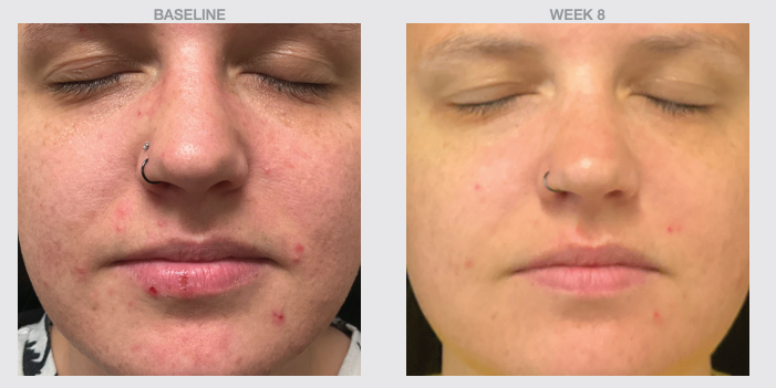 Before and after 8 weeks using Nazarian Skin Clear 1 Gly Sal Foaming Cleanser, showing reduced acne