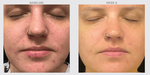 Before and after results using NazarianSkin Clear 1 acne cleanser showing reduced breakouts clearer skin tone and smoother.