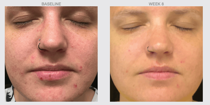 Before and after results using NazarianSkin Clear 1 acne cleanser showing reduced breakouts clearer skin tone and smoother.