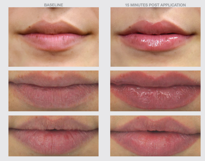 Before and after 15 minutes using Nazarian Skin Lip Boost SPF30, showing enhanced lip volume and hydration