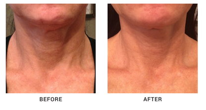 Before and after using Nazarian Skin Peptide Rich Hydrating Firming Neck Cream, showing visible reduction in neck lines