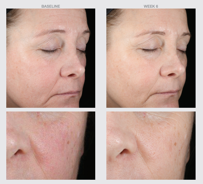 Before and after results over six weeks using NazarianSkin HA Boost Hydrating Copper Firming Serum