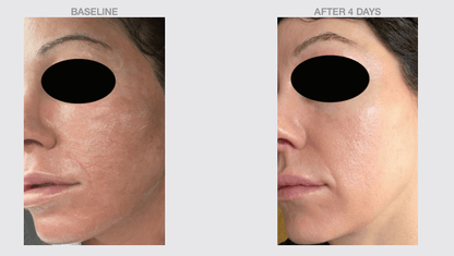 NazarianSkin Phyto Balance Serum before and after results showing reduced redness improved skin clarity and smoother texture