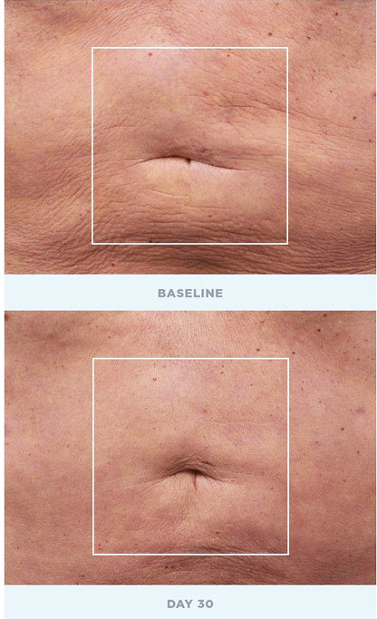 Baseline and Day 30 comparison using NuFACE NuBODY Toning & Firming Kit showing skin firming progress