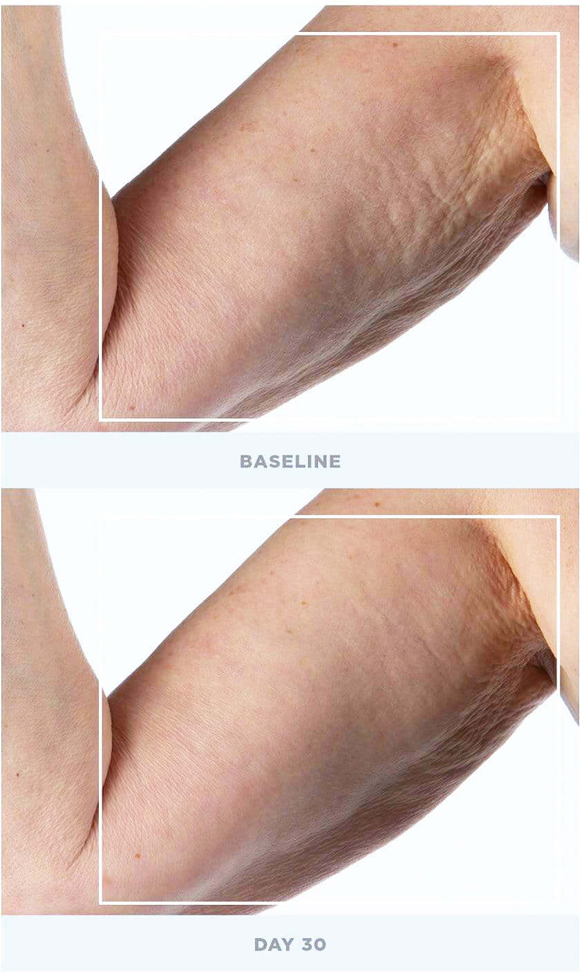 NuFACE NuBODY arm baseline and day 30 comparison shows microcurrent body toning for smoother skin and reduced dimple texture