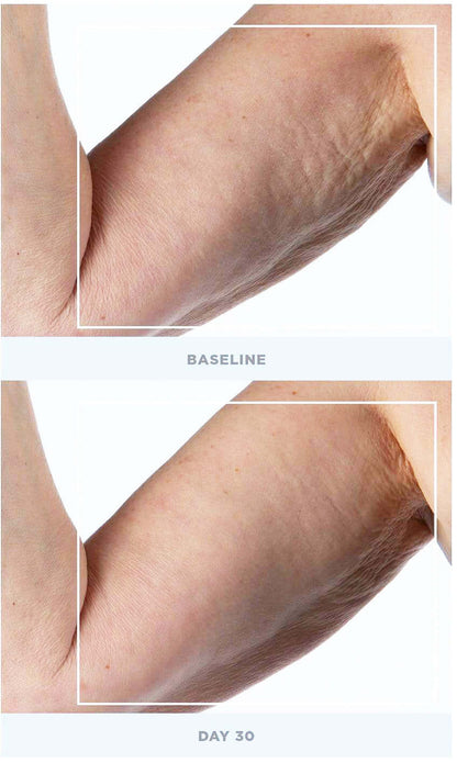 NuFACE NuBODY arm baseline and day 30 comparison shows microcurrent body toning for smoother skin and reduced dimple texture