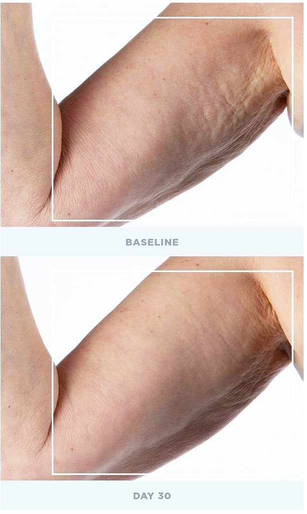 NuBODY Toning & Firming Kit results on arm, comparison from baseline to Day 30 showing improved skin firmness