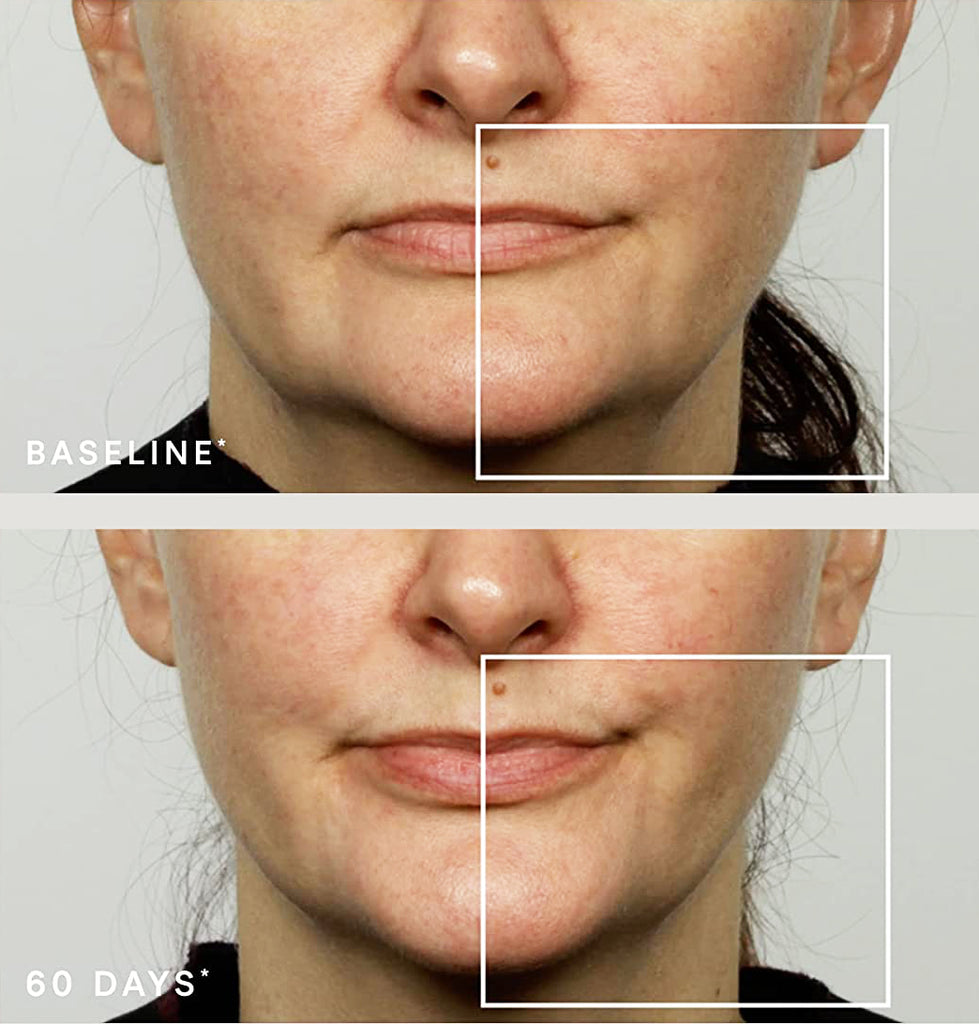 NuFACE ELE Attachment results after 60 days on lip and eye area, showing visible reduction in fine lines