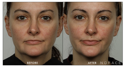 Before and after results of using NuFACE Effective Lip and Eye Attachment on full face, showing enhanced skin tone