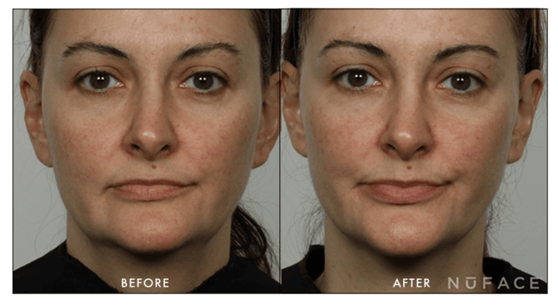 NuFACE- Effective Lip and Eye (ELE) Attachment (Non-Refundable)-The Skin Spot