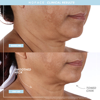 NuFACE Trinity+ PRO results after 60 days showing smoothed neck and toned chin, demonstrating clinical effectiveness