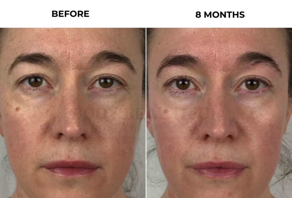 NuFACE Trinity Wrinkle Reducer before and 8 months comparison shows facial texture, tone, and visible wrinkle areas improved