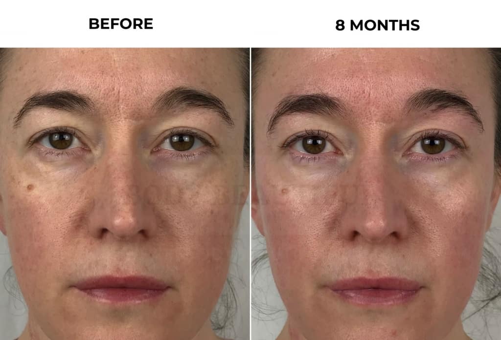 NuFACE 8-month results showing improved skin clarity and tone before and after treatment