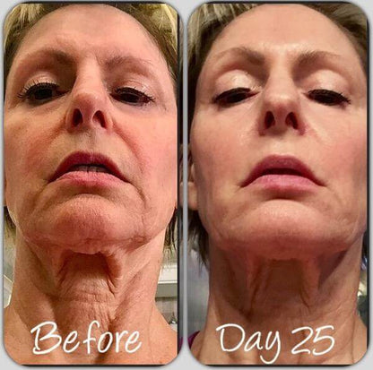 NuFACE Trinity Wrinkle Reducer before and day 25 comparison showing neck lines and skin texture after LED light use results.
