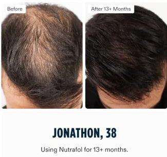 Nutrafol Core for Men effect showing hair growth progress from before to growing stage, with enhanced hair density and coverage