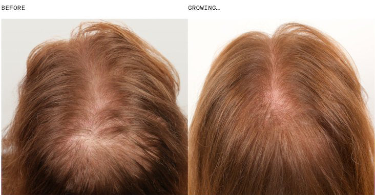 Comparison of hair density before and during treatment with Nutrafol Core for Women, showcasing noticeable regrowth