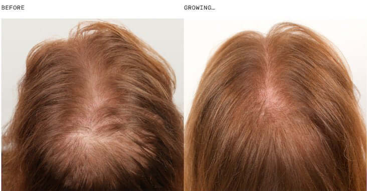 Nutrafol Core Women before and growing comparison shows scalp coverage and fuller-looking hair growth supplement results
