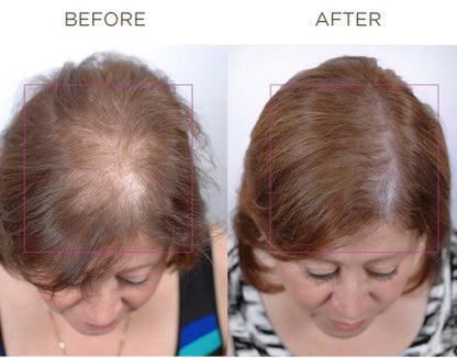 Before and after treatment with Nutrafol Core for Women, showing improved hair density and coverage in a middle-aged woman
