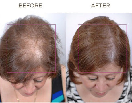 Before and after treatment with Nutrafol Core for Women, showing improved hair density and coverage in a middle-aged woman