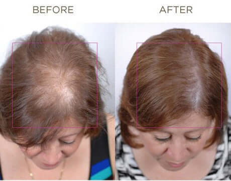 Nutrafol Core Women before and after image shows visible hair density support from nutraceutical capsules for thinning hair.