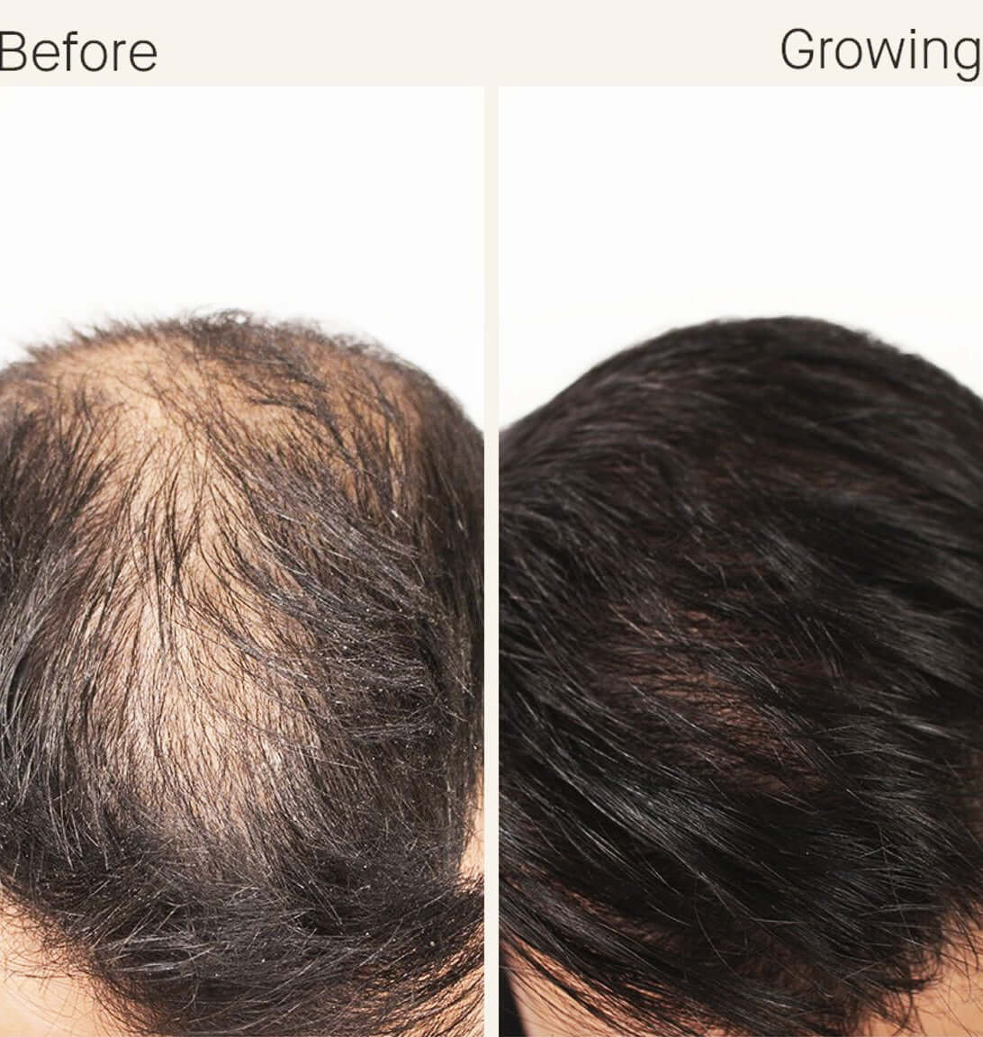 Nutrafol Hair Growth Serum before and growing comparison shows thinning crown with denser, thicker-looking hair coverage now
