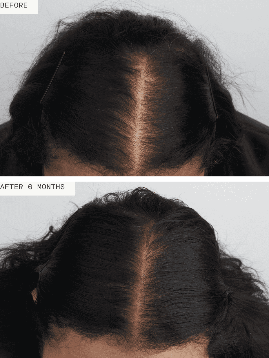 Nutrafol Women's Balance before and after 6 months shows fuller center part, less visible scalp, and thicker-looking hair
