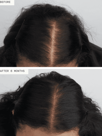 Before and after 6 months of using Nutrafol Women's Balance, showing significant hair regrowth and reduced thinning