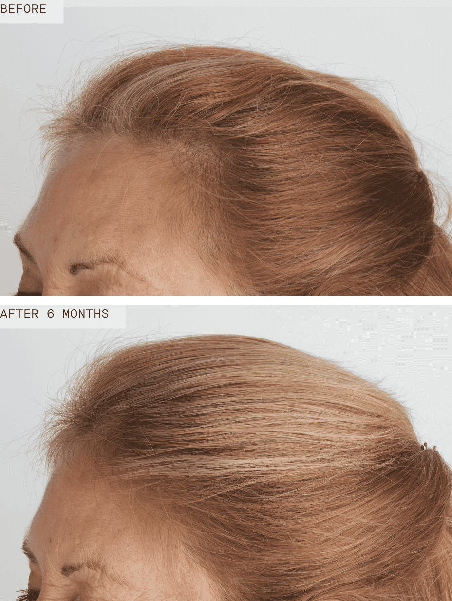 Before and after 6 months of using Nutrafol Women's Balance, showing enhanced hair volume and coverage in an older woman