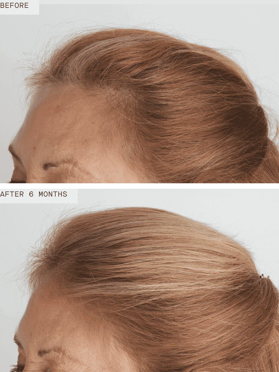 Nutrafol Women's Balance before and after 6 months shows improved temple coverage and fuller hair for menopause thinning now