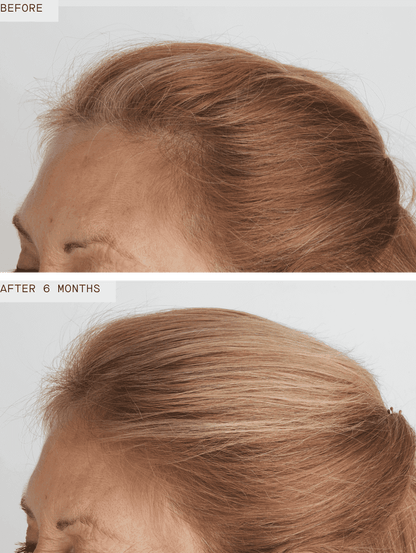 Nutrafol Women's Balance before and after 6 months shows improved temple coverage and fuller hair for menopause thinning now