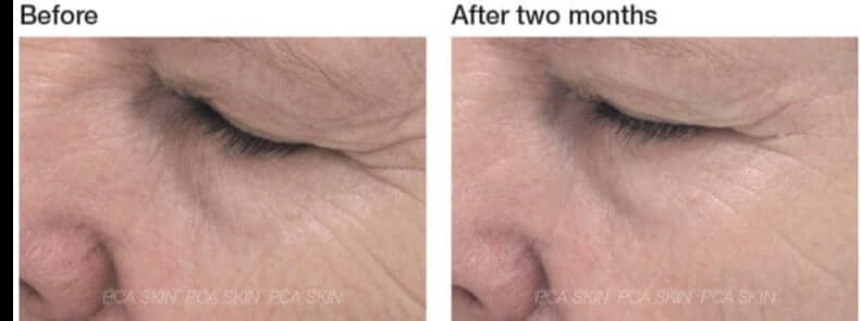 PCA Skin ExLinea Peptide Smoothing Serum before and after two months shows softer eye lines and smoother expression areas..